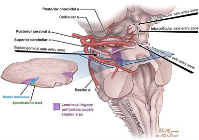 Corrigendum: Perforating Arteries of the Lemniscal Trigone: A Microsurgical Neuroanatomic Description